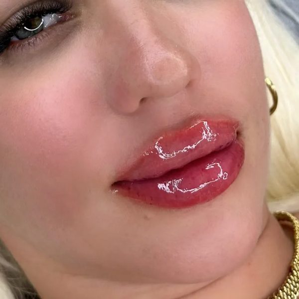 VOLUMEN EN LABIOS
