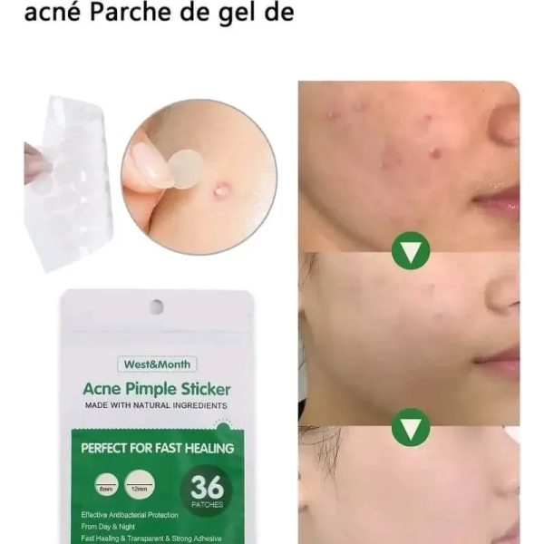 ‼️Parches para el acné ‼️