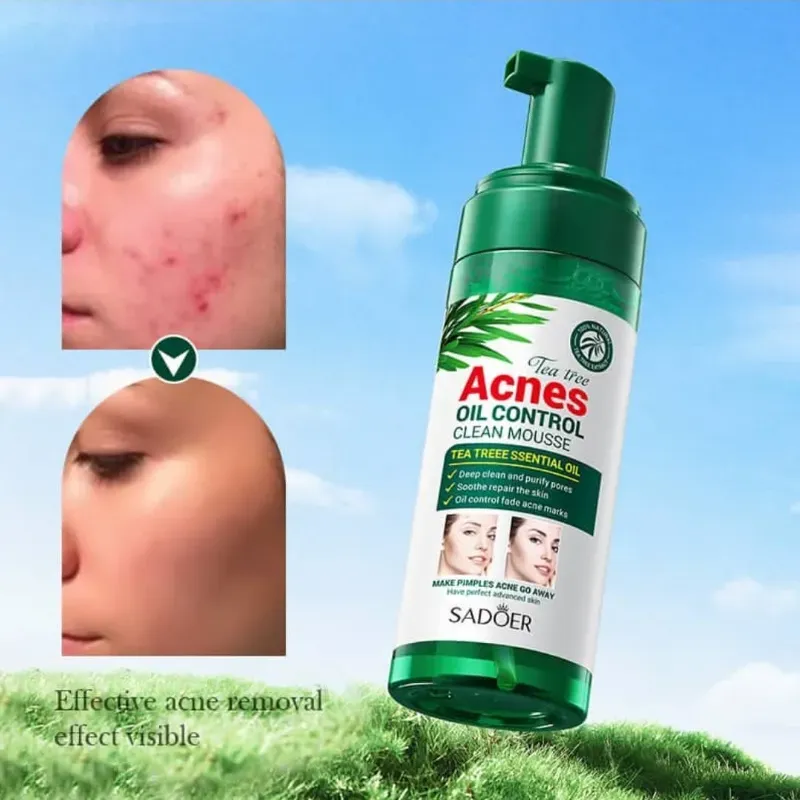 MOUSSE DE LIMPIEZA FACIAL ACNES OIL CONTROL 150G – SADOER
