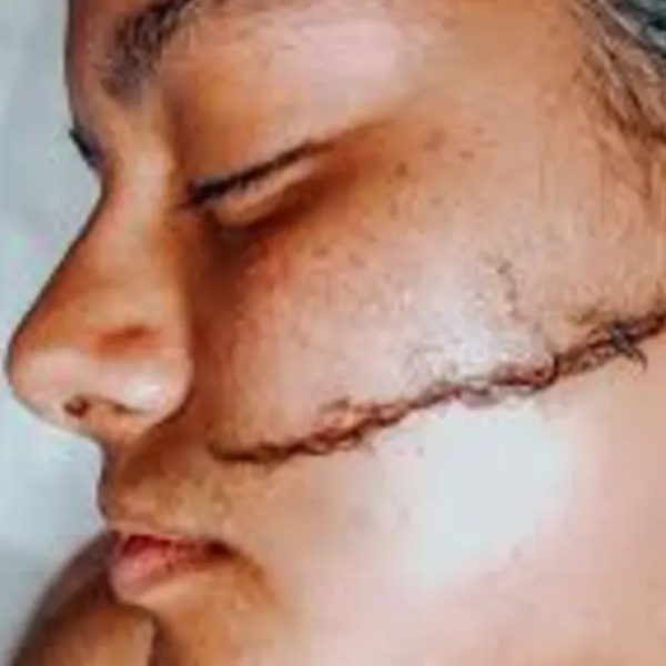  Dermaplaning 