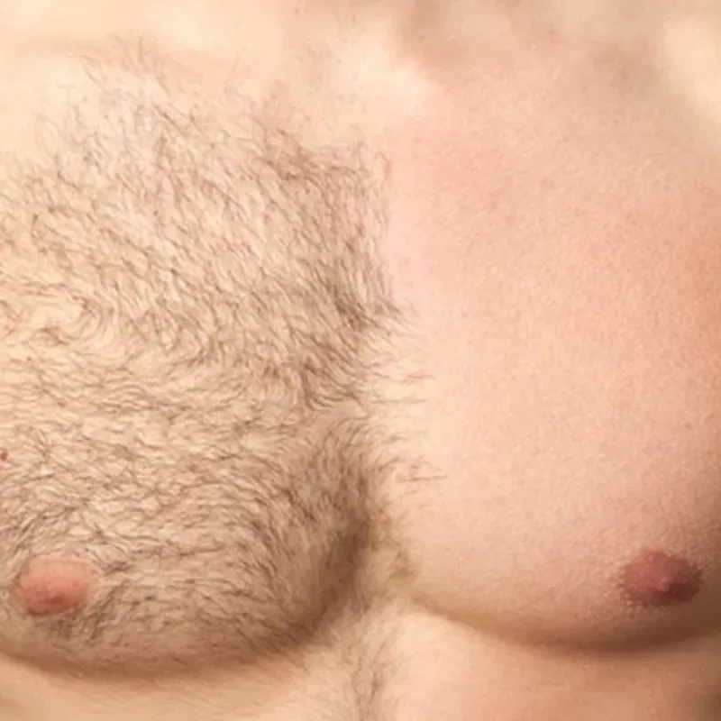 Depilación de Pecho o Abdomen