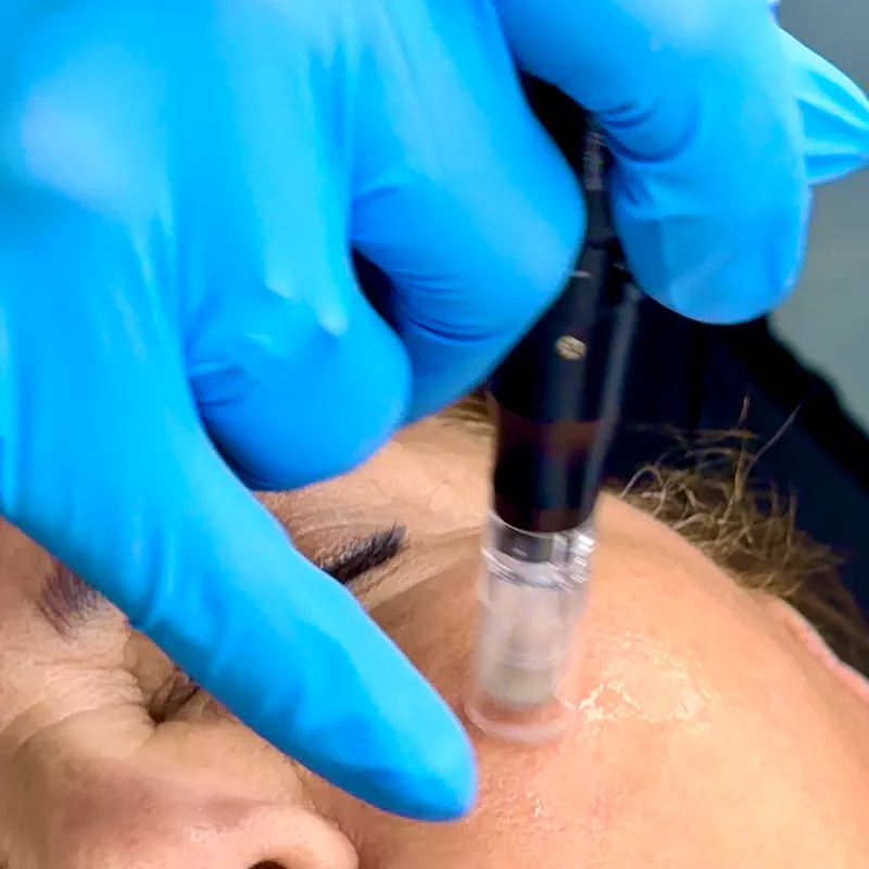 MICRONEEDLING_”Dermapen”