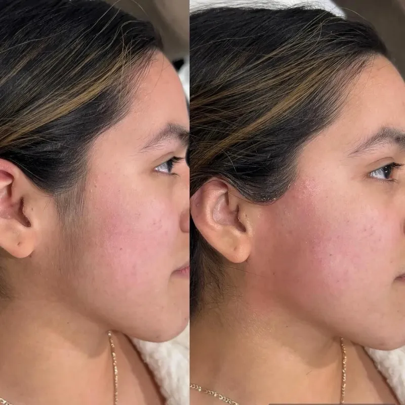 Depilación de patillas