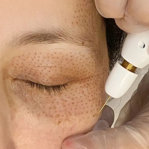Tratamiento tensor con Fibroblast