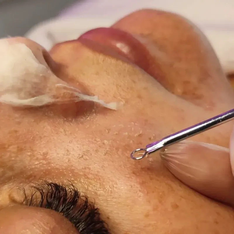 Limpieza de Cutis Profunda