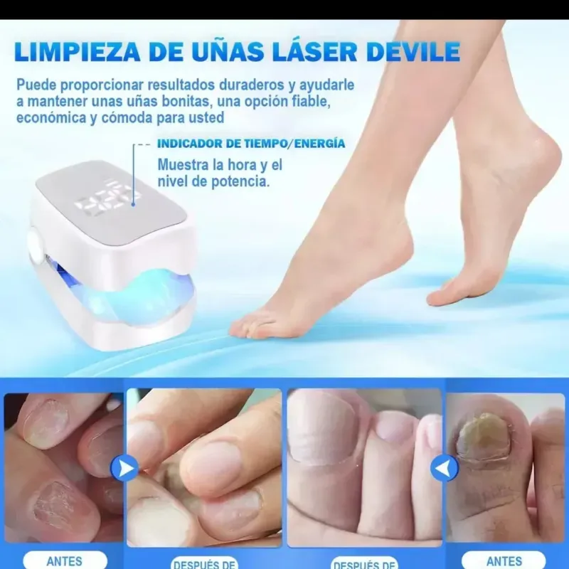 LASER TRATAMIENTO PARA UÑAS CON HONGOS