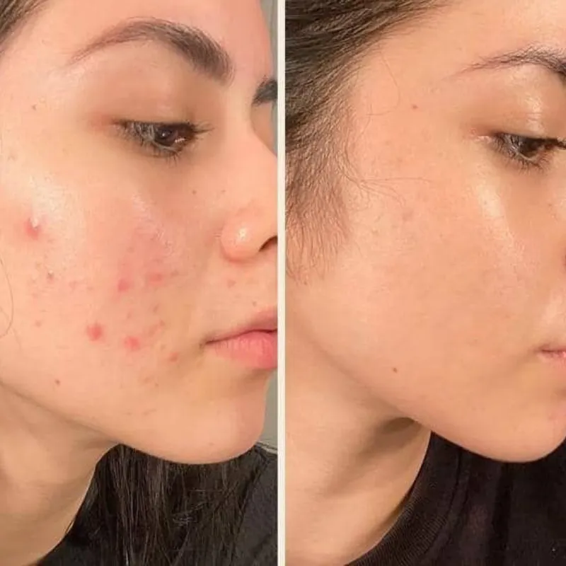 Facial antiacné