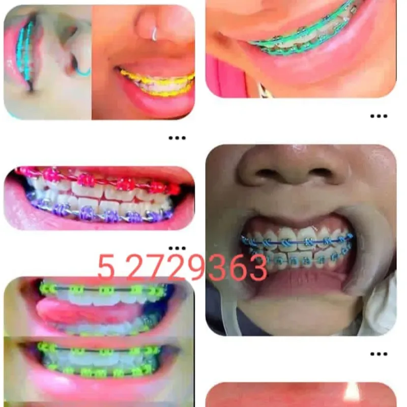 Brackets de Lujo