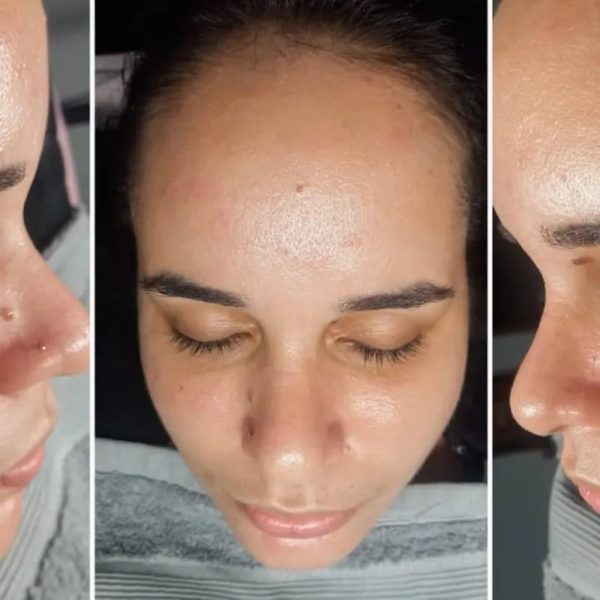 Peeling Enzimático