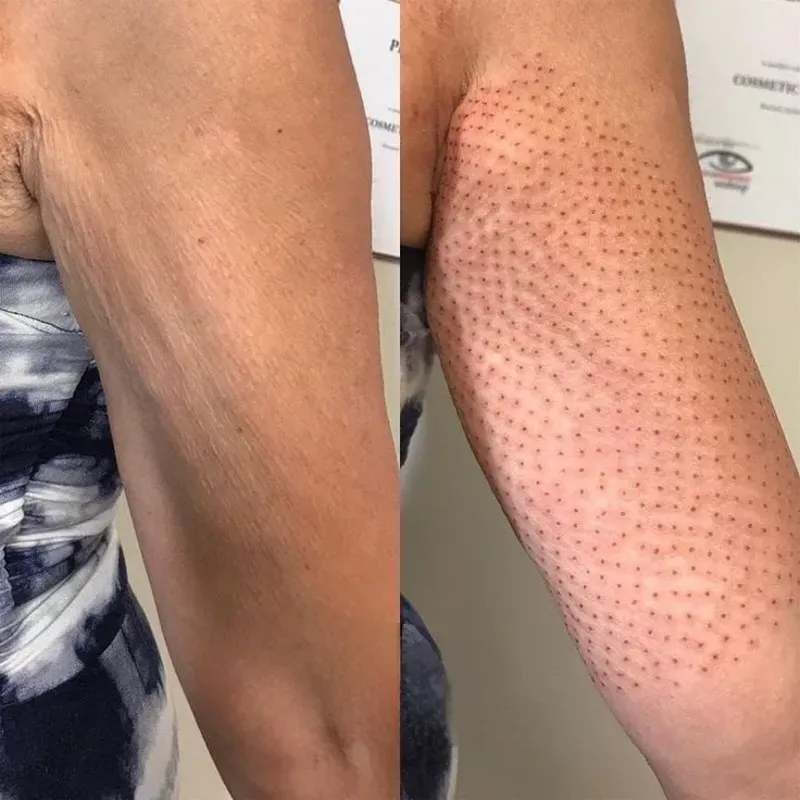 FIBROBLAST O Plasma Pen