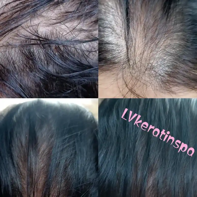 Tratamiento de regeneración capilar