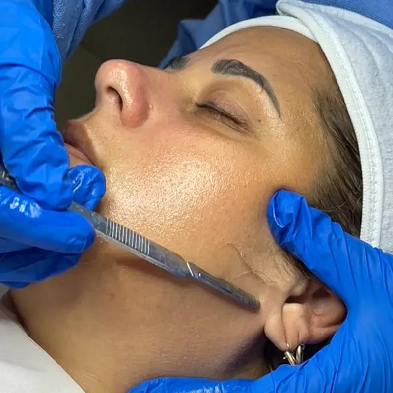 Dermaplaning Avanzado