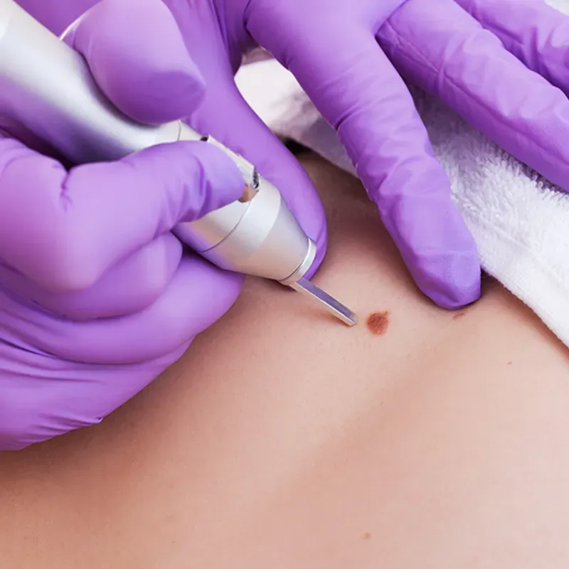 Eliminación de lesiones benignas.