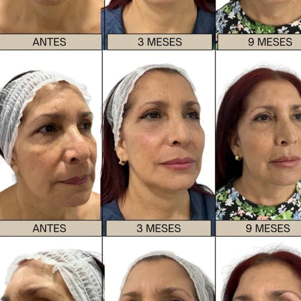 Lifting facial.