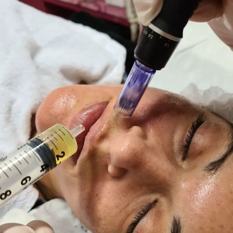 MICRONEEDLING O TERAPIA DE INDUCCIÓN DE COLAGENO