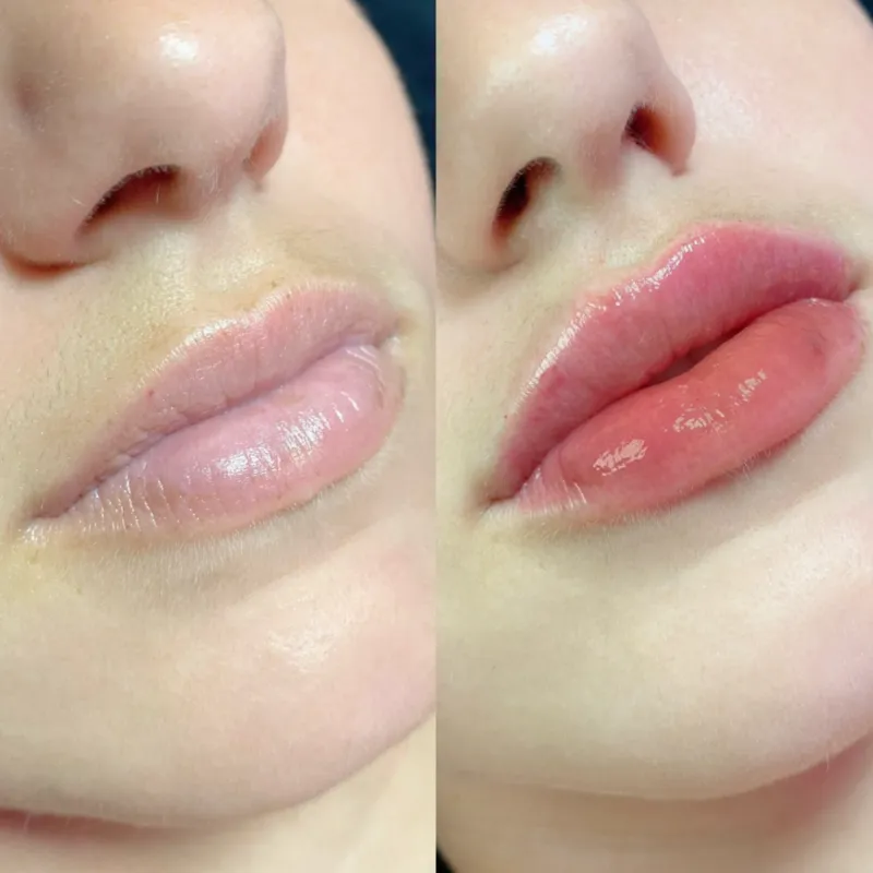 Labios con Ácido Hialurónico