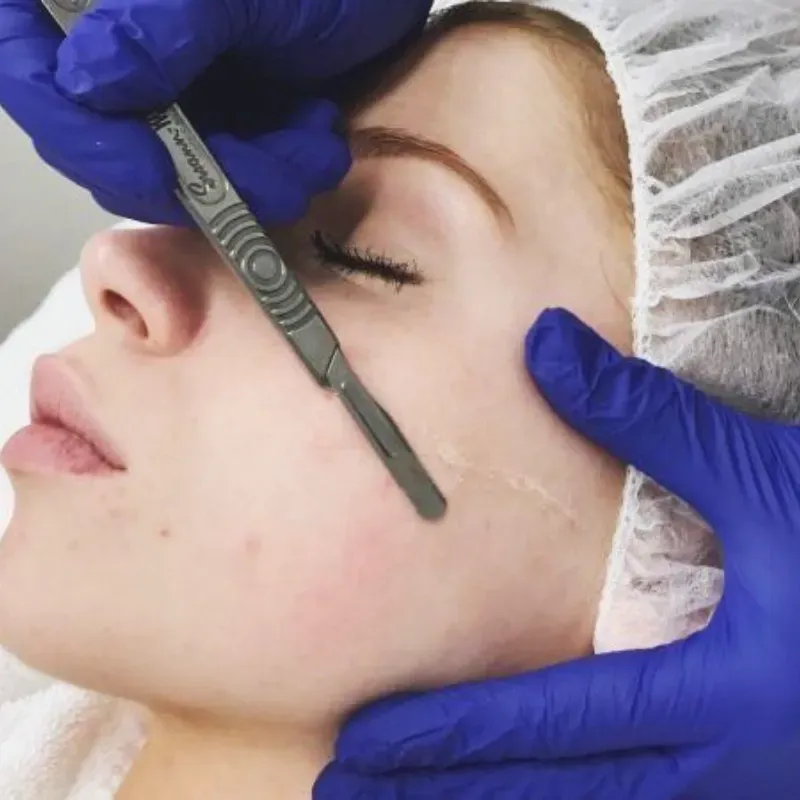 Dermaplaning tratamiento