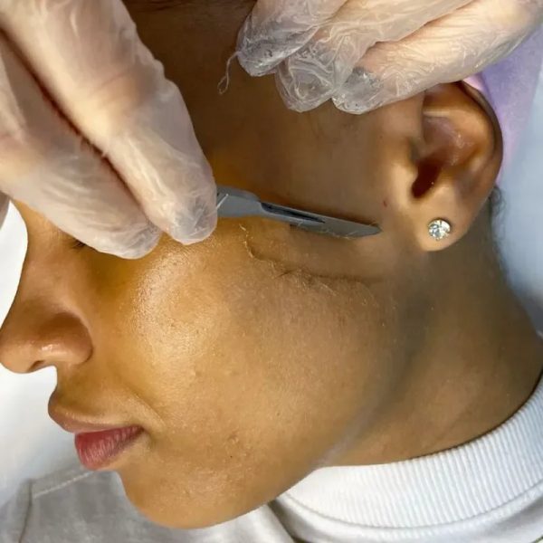 Dermaplaning Facial
