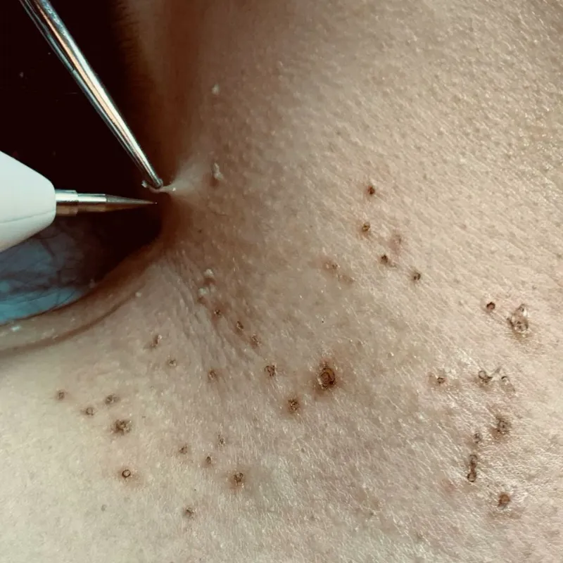 Eliminación de verrugas