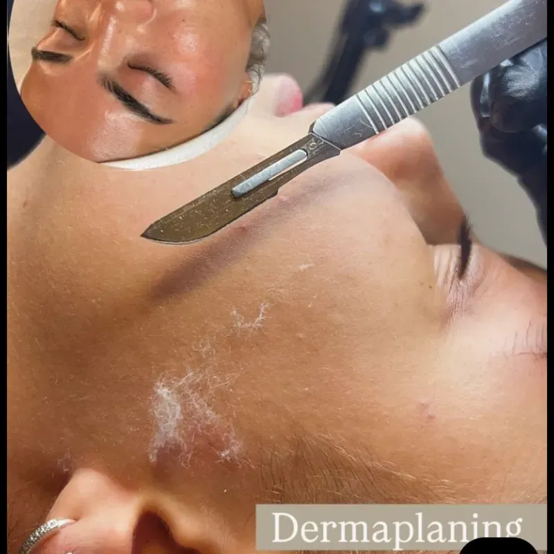 Dermaplaning