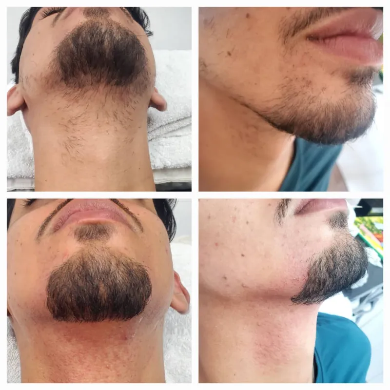 Depilación Con Cera