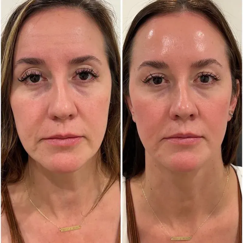 Bótox (Full Face 3 zonas) 