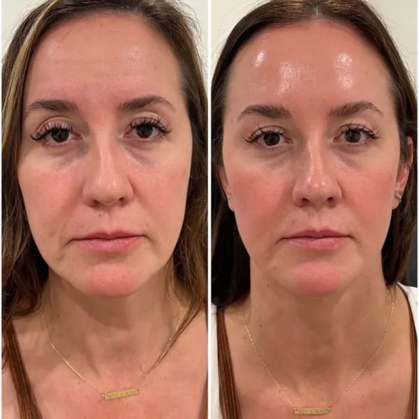Bótox (Full Face 3 zonas) 