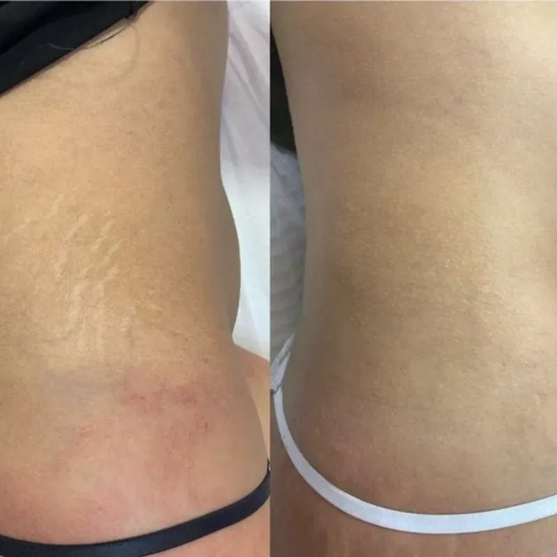 Fibroblast con plasma pen para estrías
