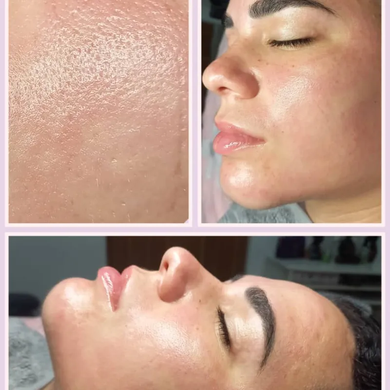 Micropunción o Microeendling facial