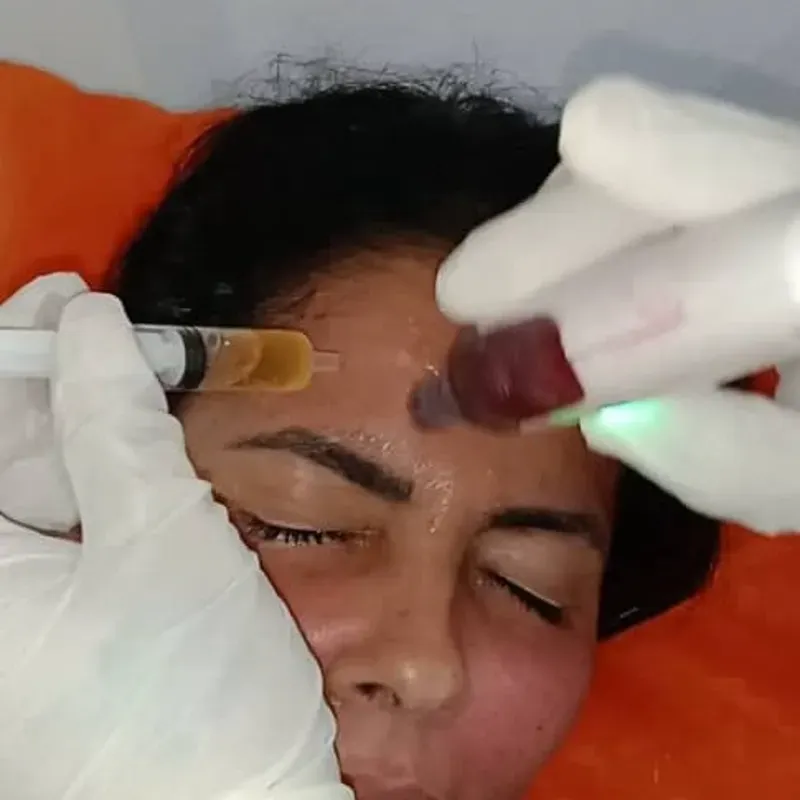 Dermapen + ácido hialurónico + vitamina C